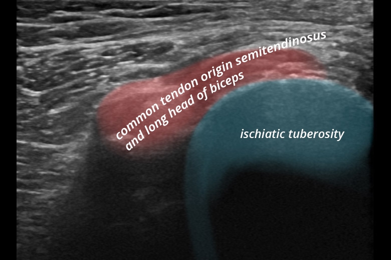 Pelvis posterior tuber ischiadicum hamstrings transverse