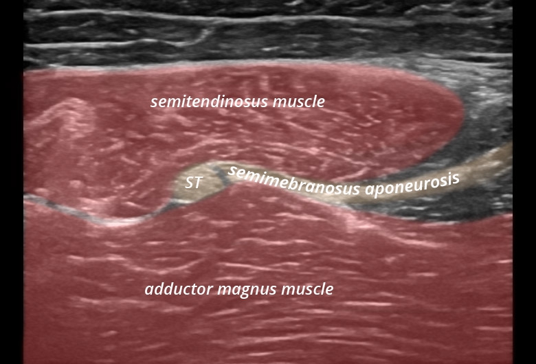 Pelvis posterior hamstrings tendons transverse