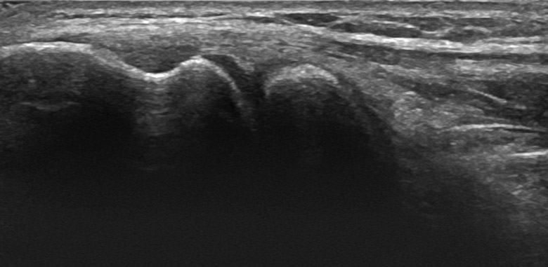 Elbow lateral humero radial lateral epicondyle longitudinal