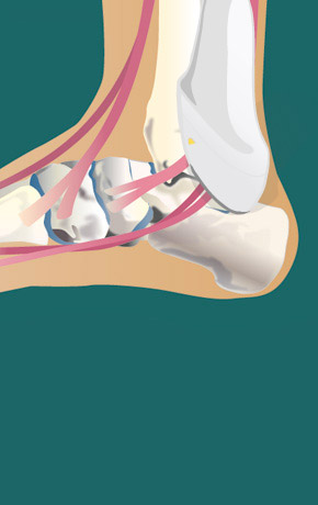 Injection tibialis anterior tendon with hyaluronic acid | SonoTool®