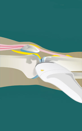 Lateral tendons – longitudinal | SonoTool®