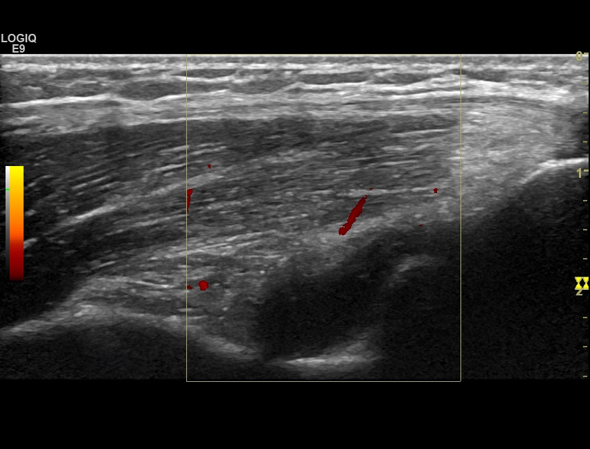 [SpA] Synovial effusion: olecranon fossa | SonoTool®