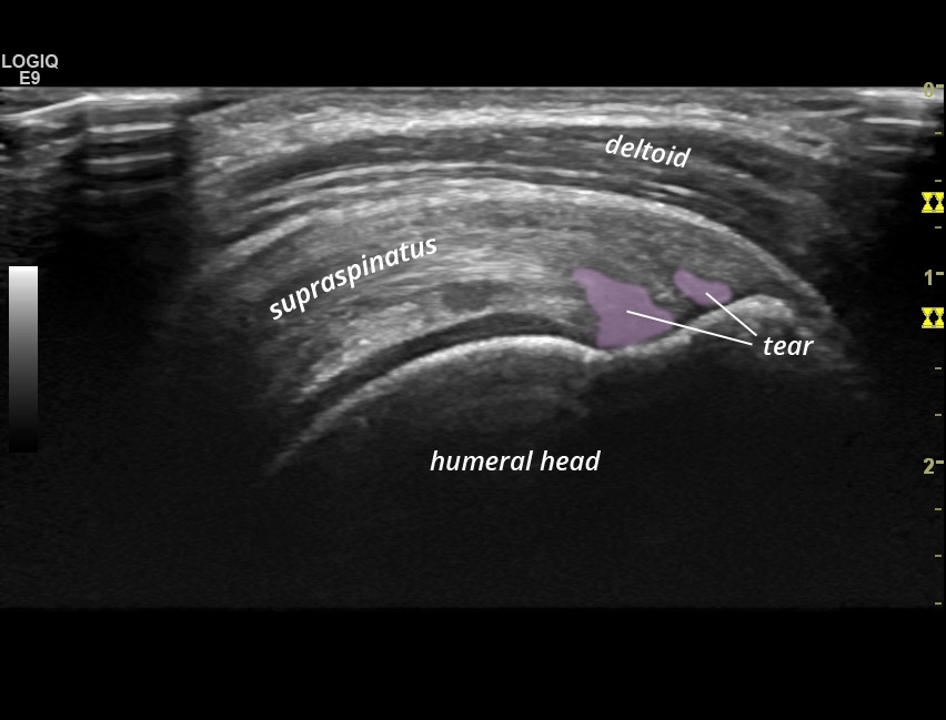 Partial Thickness Tear Supraspinatus Tendon