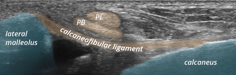 Antero-lateral ligaments – longitudinal | SonoTool®