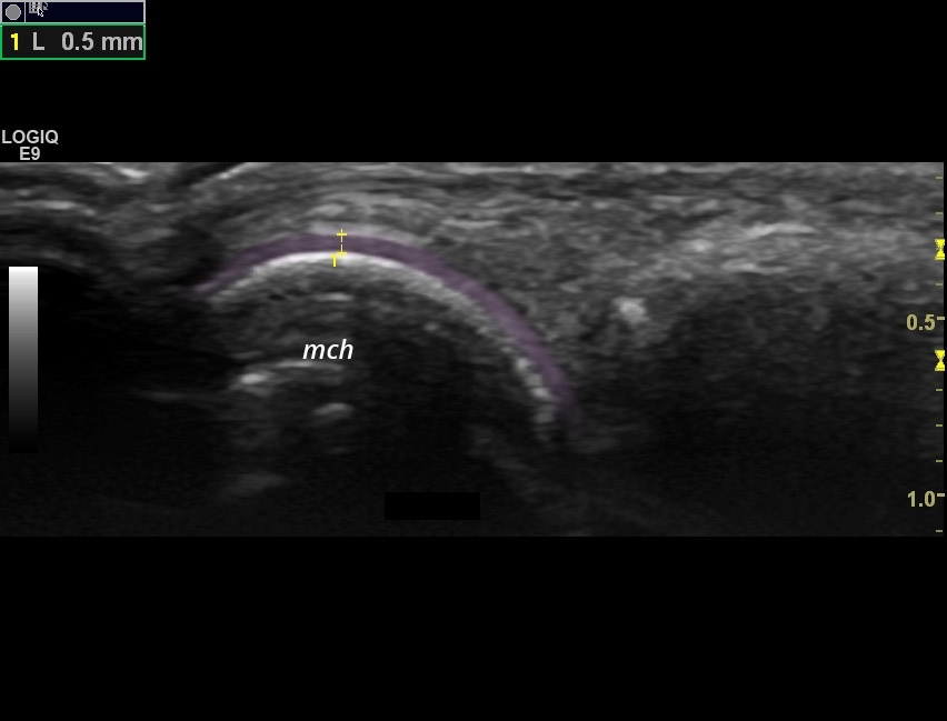 [RA] Cartilage measurement in rheumatoid arthritis | SonoTool®