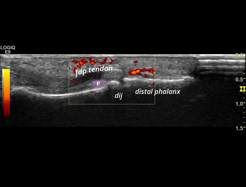 Psa Enthesitis Of The Flexor Tendon Dij Sonotool®