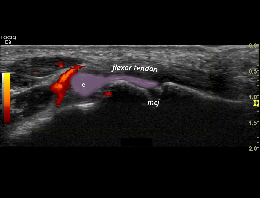 [RA] Synovitis MCP joints SonoTool®