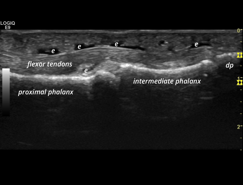 [SpA] Flexor Tendons Tenosynovitis | SonoTool®