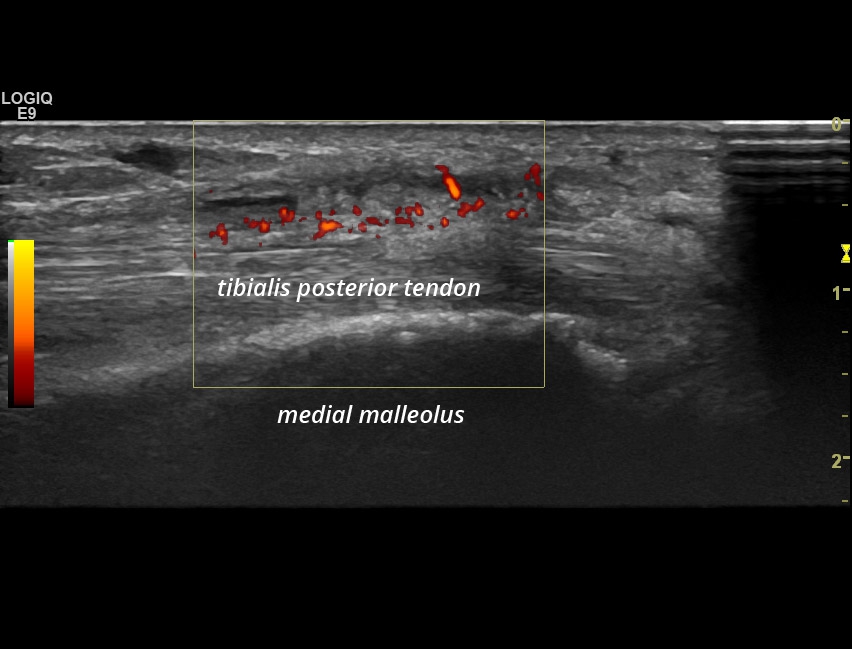 Tenosynovitis Tibialis Posterior And Flexor Digitorum Longus Tendon Sonotool® 5214