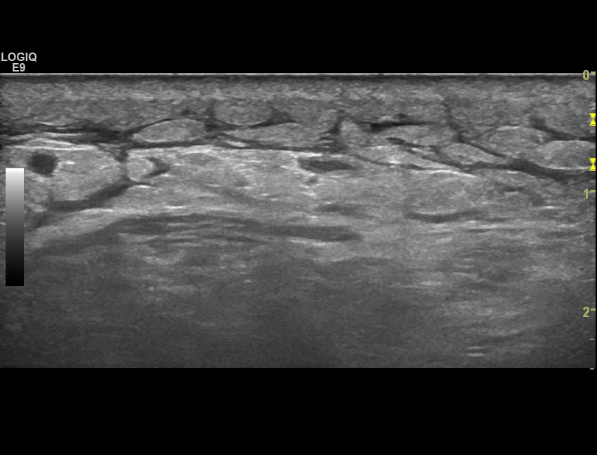 postraumatic-subcutaneous-edema-of-the-ankle-sonotool