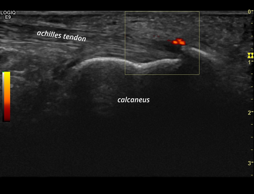 [SpA] Achilles Tendon Enthesitis | SonoTool®