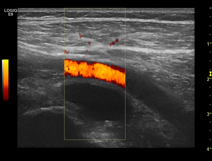 Bursitis iliopectinea | SonoTool®