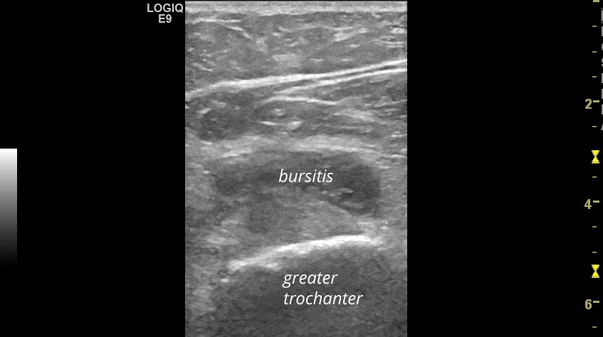 Trochanteric bursitis | SonoTool®