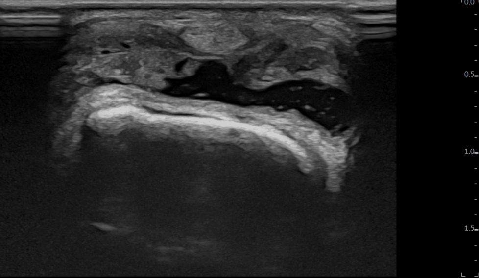 Crystal arthropathy | SonoTool®