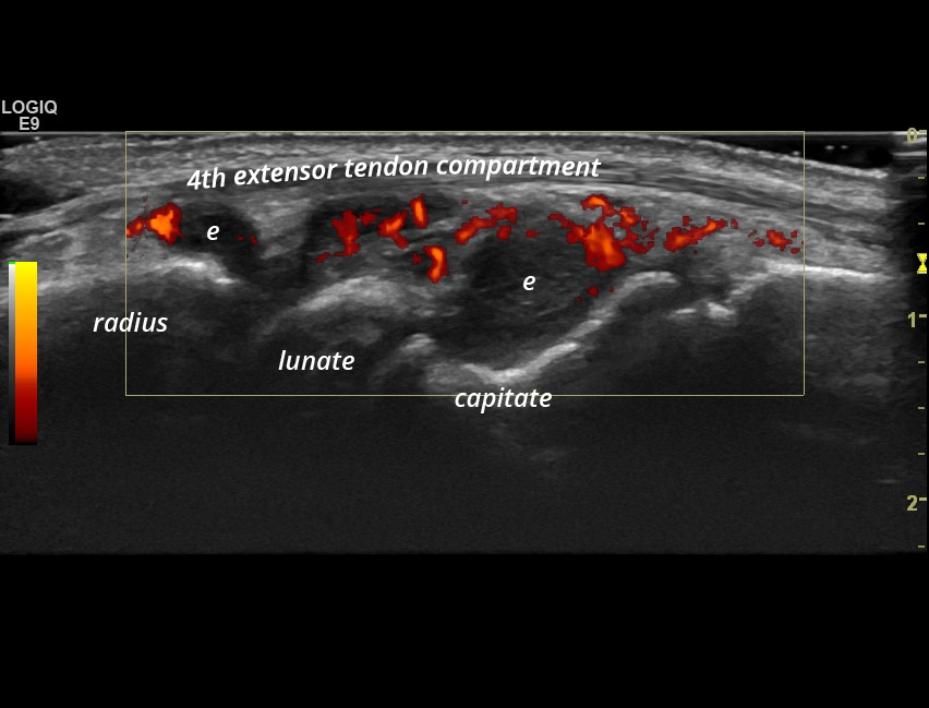 Ra Synovitis Of The Wrist Sonotool®